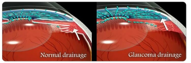 Glaucoma Treatment
