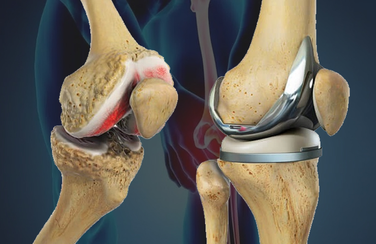 Best Orthopedic Surgeon in Indore | Dr. Sanjay Rawat