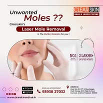 Best Birthmark removal laser treatment in india