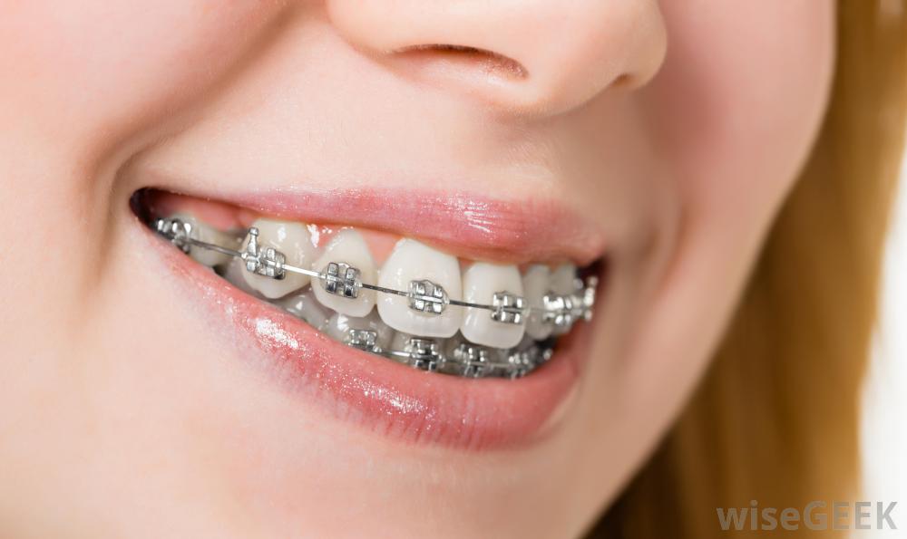 How much does a Invisalign retainer cost?
