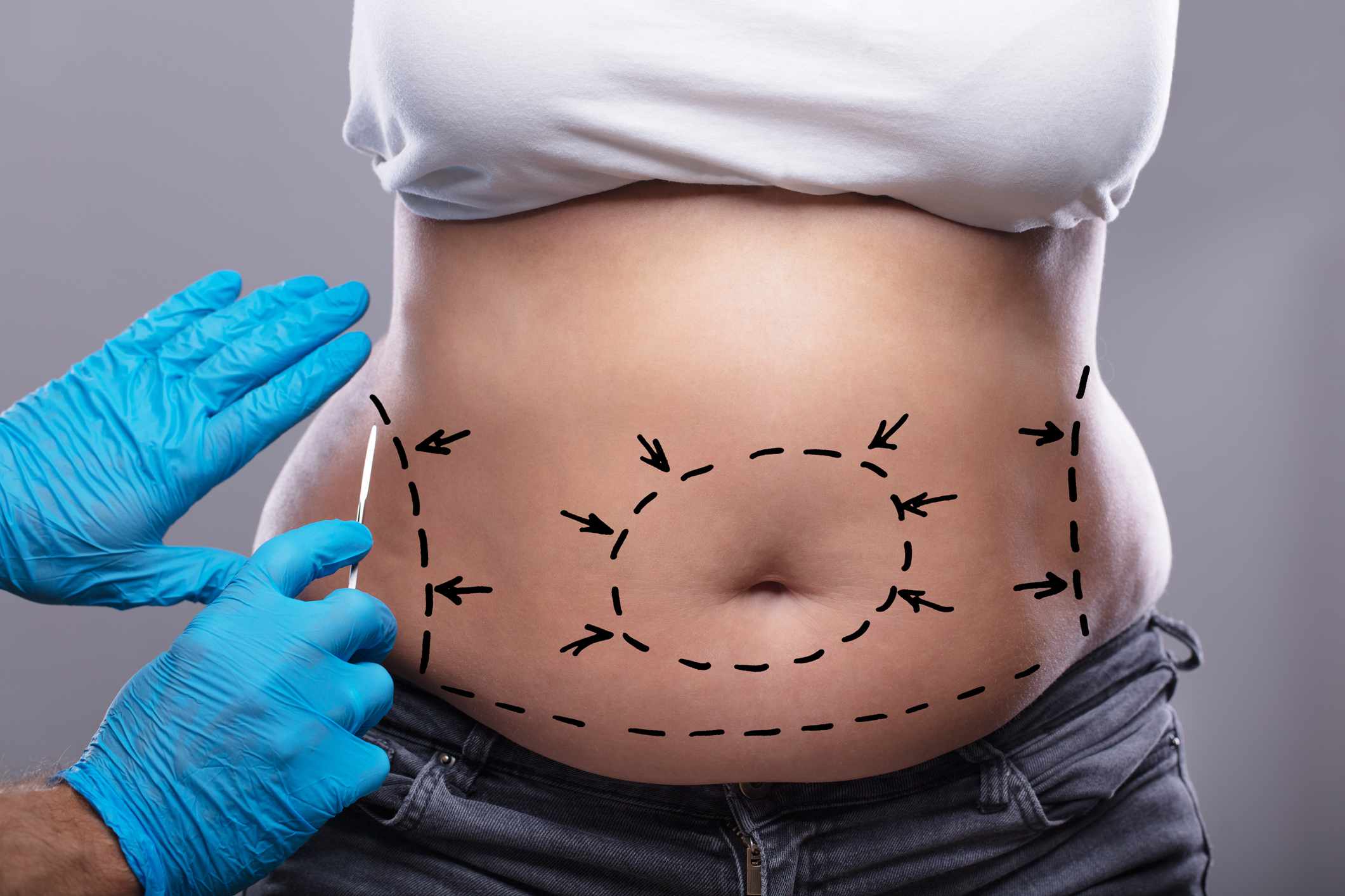 Breast Reduction Surgery in Gurgaon