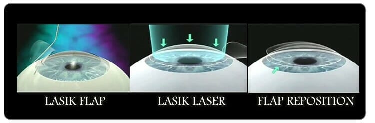 Relex Smile Eye Surgery
