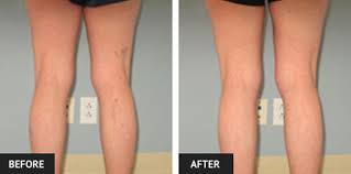 After sclerotherapy for varicose or spider veins