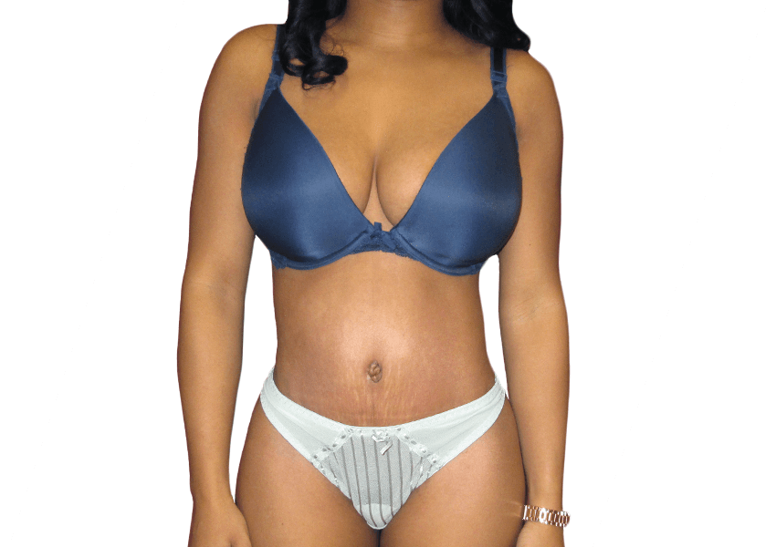 Tummy Tuck Houston Cost