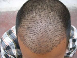 Best Doctor for Hair Transplant in Delhi, South Delhi