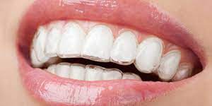 Invisalign Orthodontist Near Hollywood, Fl