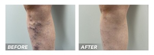 Top Varicose Vein Doctors Near Me
