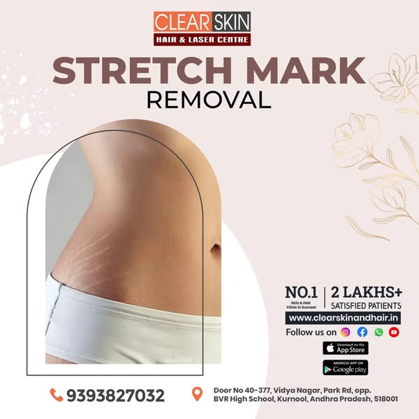 Hair Transplant Treatment in india
