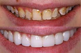 Different Types of Veneers
