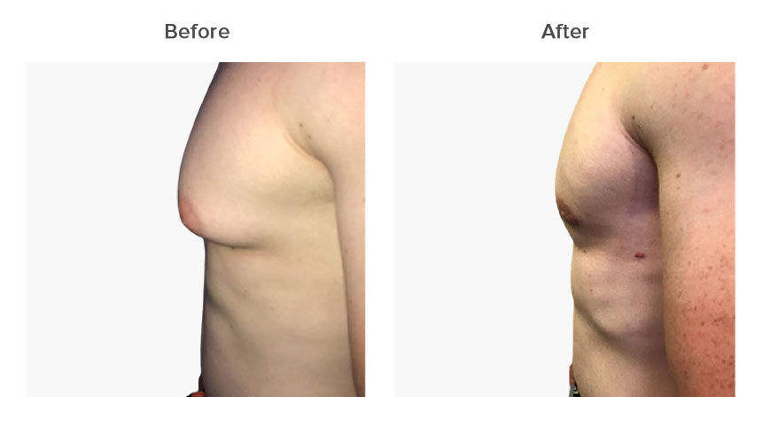 Gynecomastia Surgery in Delhi at LA Clinic