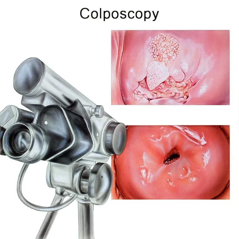 Colposcopy Procedure NY