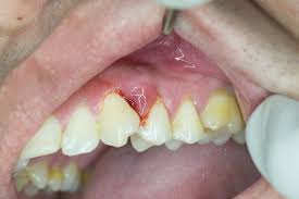 Professional Dental Teeth Cleaning