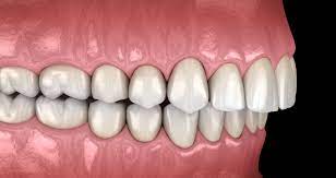 Tips On Overbite After Braces