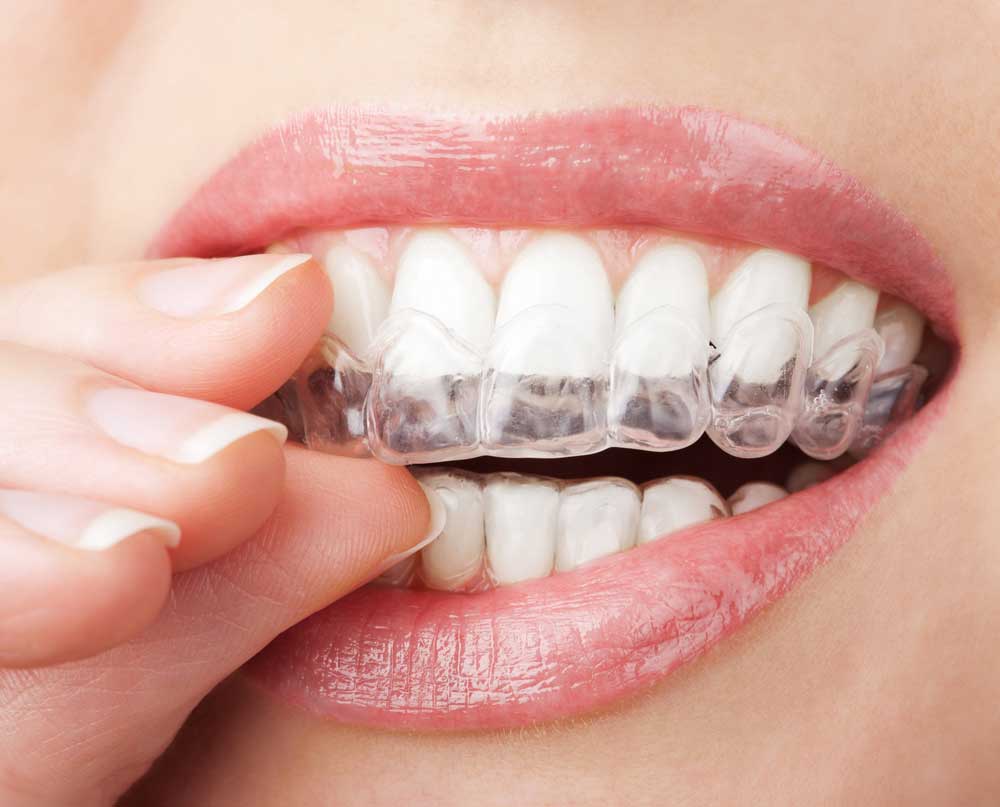Impacted Wisdom Tooth Extraction