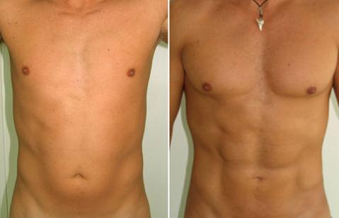 Vaser Liposuction Results Before After