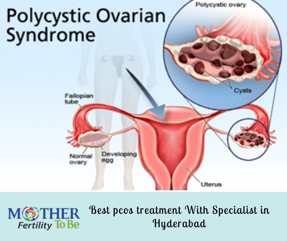 Best pcos treatment with pcos specialist in Hyderabad