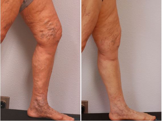 Clifton Varicose Vein Treatment Center