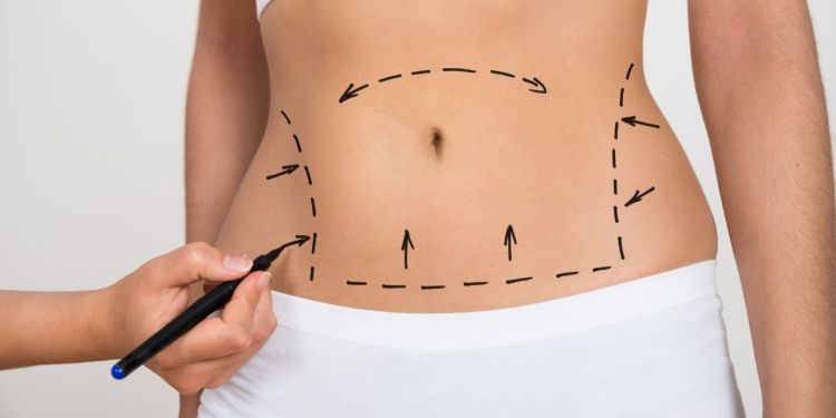 Liposuction Surgery in Gurgaon