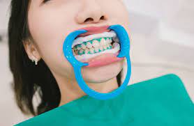 In Office Teeth Whitening Near Me