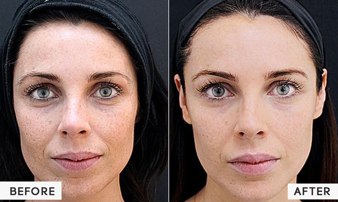 Best Dermal Fillers in Noida