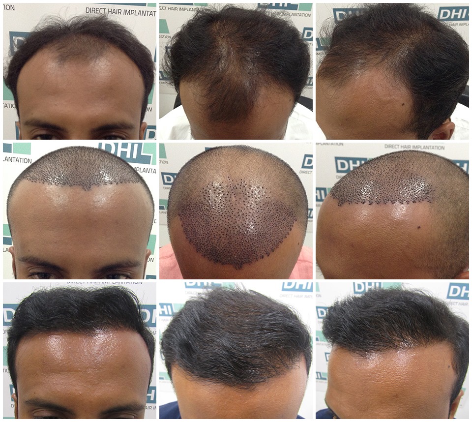 Consult the most trusted hair transplant surgeons in Delhi