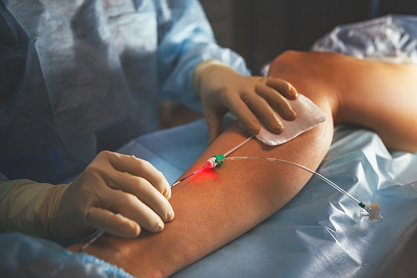vein Treatment center Houston