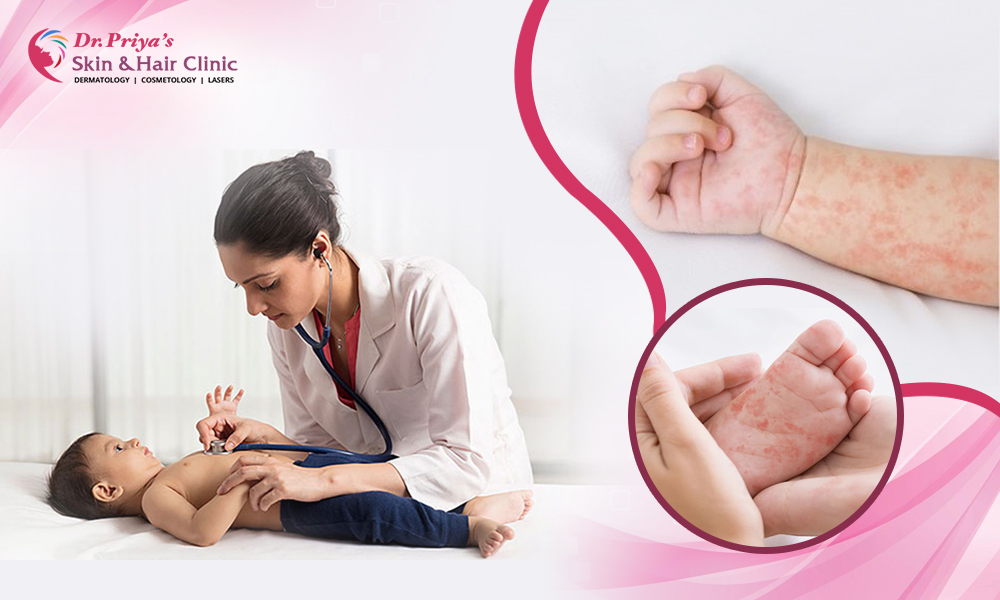Leading Pediatric Dermatologist in Marathahalli, Bangalore - Dr. Priya Skin and Hair Clinic