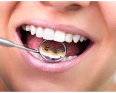 Teeth Bonding Near me