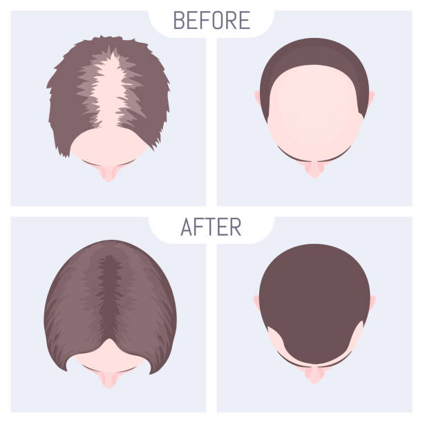Best Hair Transplant in London