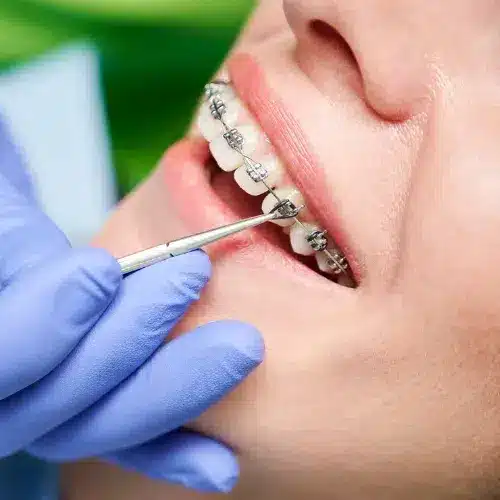 Teeth Braces Cost in Ahmedabad
