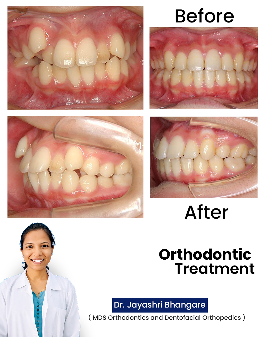 Orthodontic Treatment