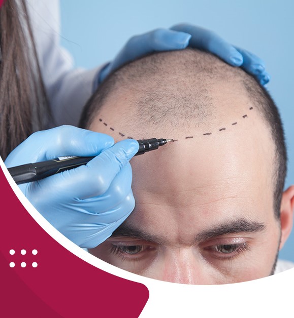 Hair Transplant Treatment