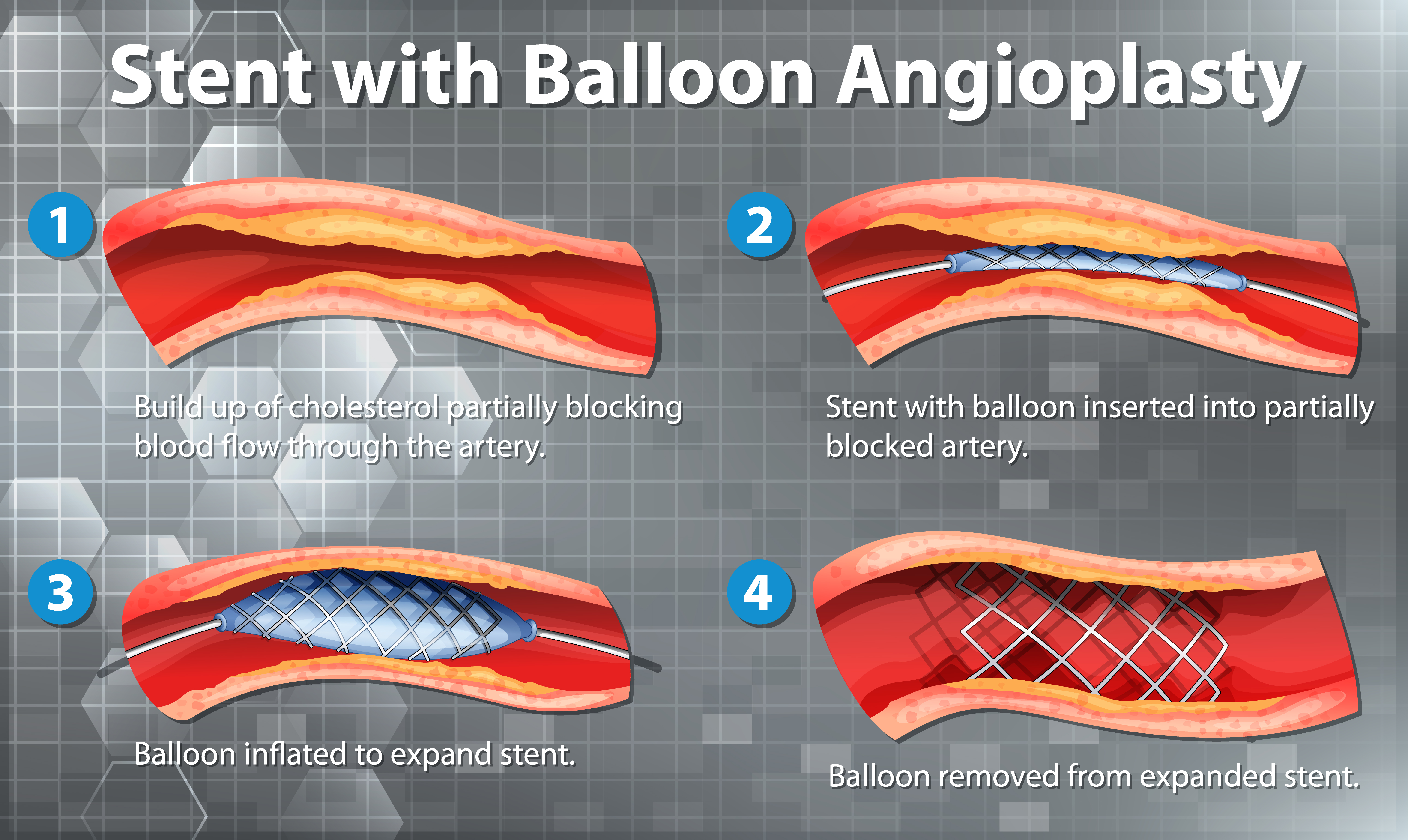 Coronary Angioplasty in Rewa