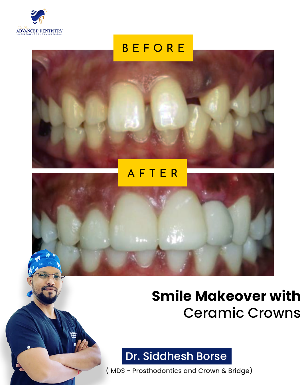 Ceramic Crowns