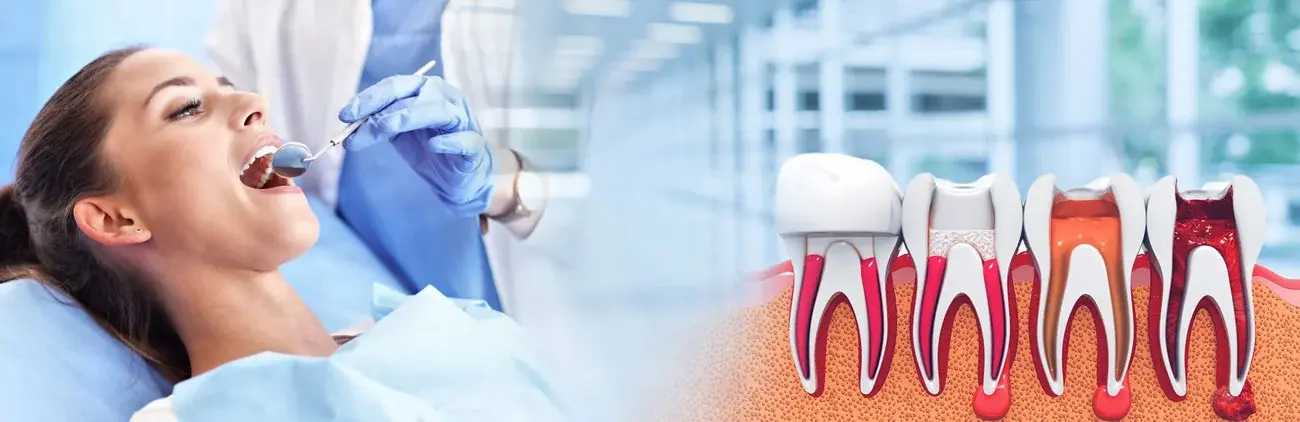 Root canal treatment cost in Ahmedabad