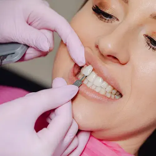 Dental Veneers in Ahmedabad