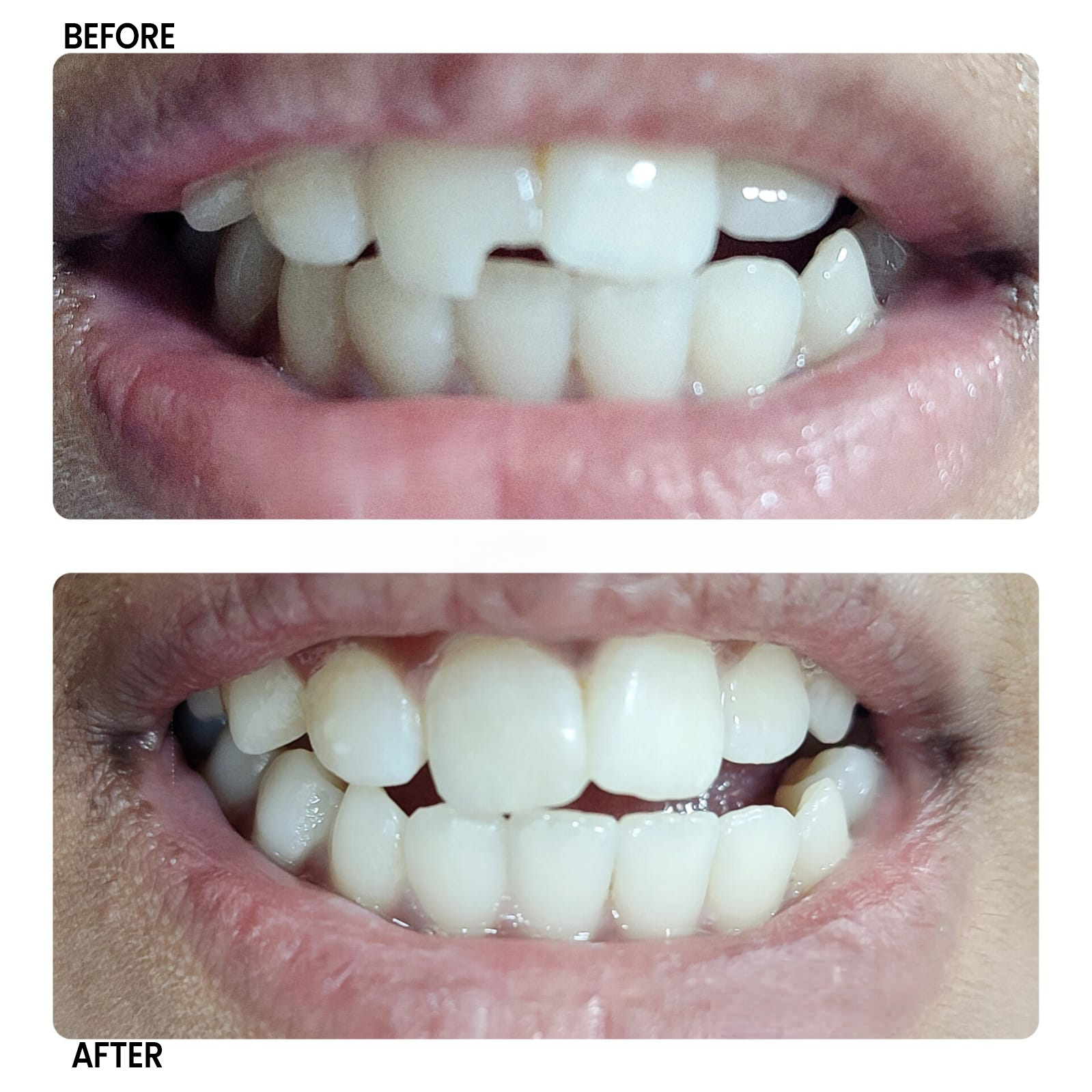 Composite Filling