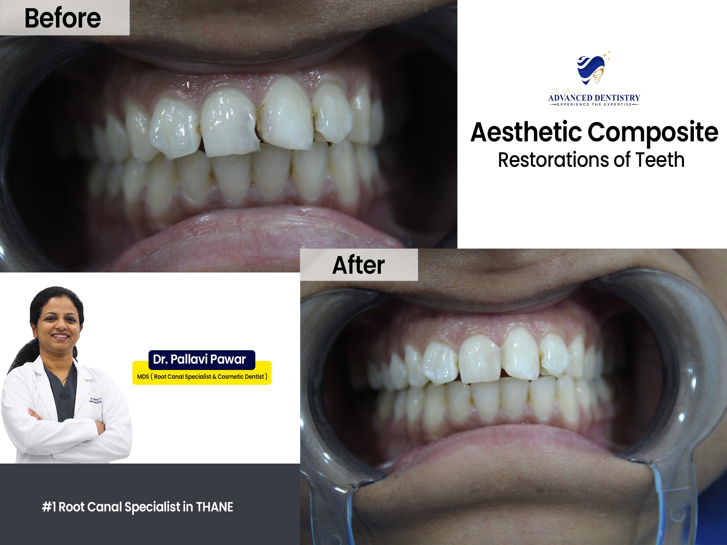 Aesthetic Composite Restoration