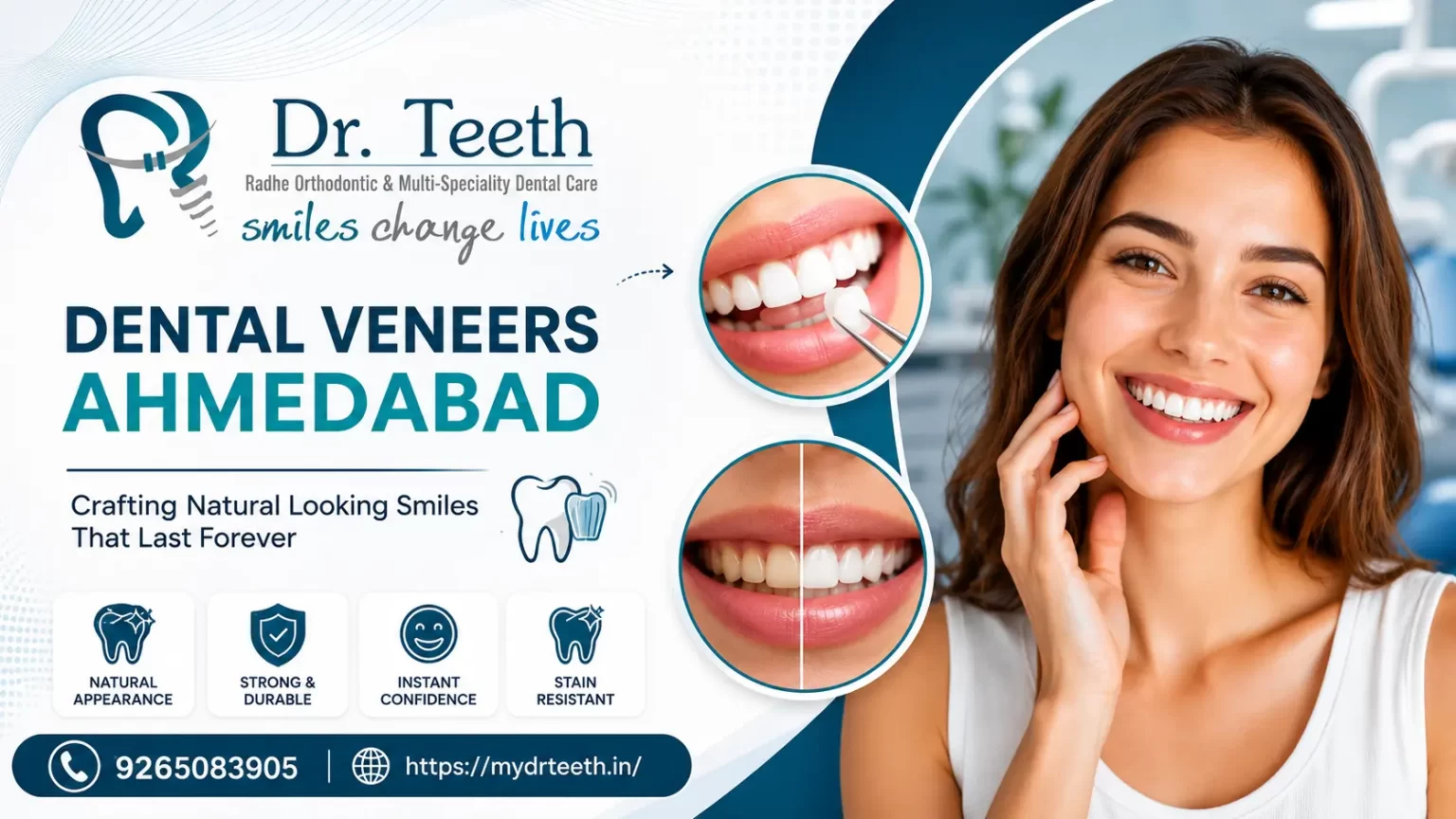 Dental Veneers Ahmedabad